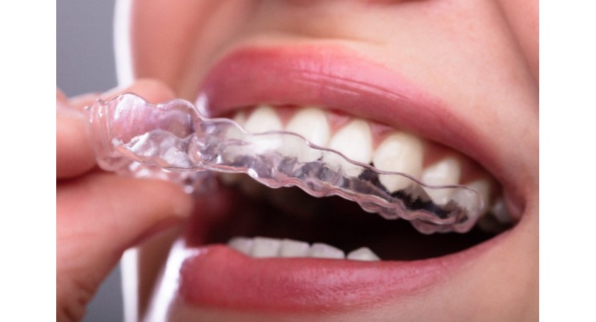 Que faut-il savoir sur l’orthodontie par gouttières ?